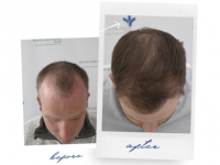 Sponsored: Treatments For Hair Loss At The Cosmetic And Hair Restoration Clinic
